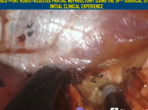 Robot-Assisted Single Port Partial Nephrectomy Using the SP Surgical System