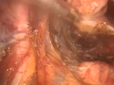 Robotic abdominoperineal resection for Low Rectal Cancer with Senhance Transenterix Robotic Platform Robotic abdominoperineal resection for Low Rectal Cancer with Senhance Transenterix Robotic Platform
