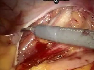 Robotic Anterior Resection of T4 Rectal Cancer with Bladder Resection & Reconstruction Robotic Anterior Resection of T4 Rectal Cancer with Bladder Resection & Reconstruction