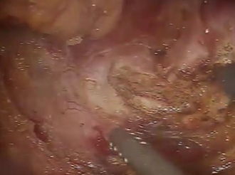 Robotic Assisted Laparoscopic Extralevator Abdominoperineal Reseection (ELAPR) Robotic Assisted Laparoscopic Extralevator Abdominoperineal Reseection (ELAPR)