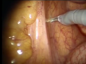 Robotic-assisted Laparoscopic Hartman's Procedure for Diverticular Colonic Obstruction Robotic-assisted Laparoscopic Hartman's Procedure for Diverticular Colonic Obstruction