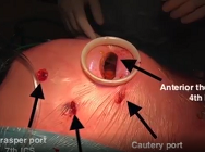 Robotic-assisted MIDCAB grafting in single vessel disease