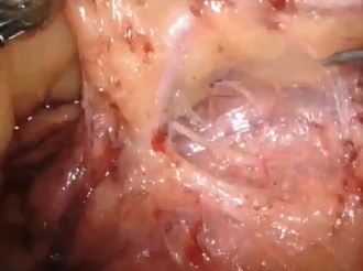 Robotic-asst Low Anterior Resection: Beyond TMELeft Vascular Approach & Pre-sacral Fascia Excision. Robotic-asst Low Anterior Resection: Beyond TMELeft Vascular Approach & Pre-sacral Fascia Excision.