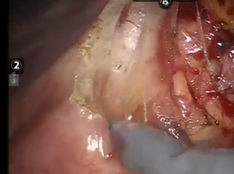 Robotic D4 Lymph Node Dissection for the Treatment of Rectal Cancer