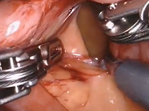 Robotic Distal Ureterectomy with Uretero-enteric Reimplant