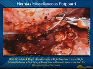 Robotic enblock Right Hepatectomy + Right Nephrectomy + Right Adrenalectomy