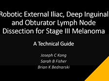 Robotic External Iliac, Deep Inguinal and Obturator Lymph Node Dissection for Stage III Melanoma Robotic External Iliac, Deep Inguinal and Obturator Lymph Node Dissection for Stage III Melanoma