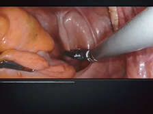 Robotic Frykman-Goldberg procedure for complete rectal prolapse A video vignette Robotic Frykman-Goldberg procedure for complete rectal prolapse A video vignette