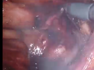 Robotic Intersphinteric Resection with Lateral Pelvic Lymph Node Dissection for Distal Rectal Cancer Robotic Intersphinteric Resection with Lateral Pelvic Lymph Node Dissection for Distal Rectal Cancer