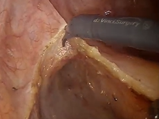 Robotic Low Anterior Resection For A Re-growth Following Complete Clinical Response Robotic Low Anterior Resection For A Re-growth Following Complete Clinical Response