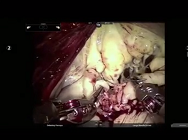 Robotic mitral repair w/sliding leaflet valvuloplasty and remodelling partial annuloplasty Robotic mitral repair w/sliding leaflet valvuloplasty and remodelling partial annuloplasty