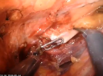 Robotic Posterior Pelvic Exenteration for Locally Advanced Rectal Cancer