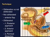 Robotic Posterior Urethroplasty for Radiation Induced Posterior Urethral Stenosis Robotic Posterior Urethroplasty for Radiation Induced Posterior Urethral Stenosis