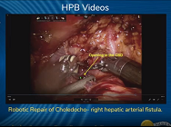 Robotic Repair of Choledocho- right hepatic arterial fistula