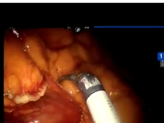 Robotic Right Colectomy For Cancer