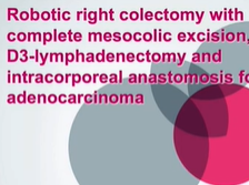 Robotic right colectomy with CME and D3-lymphadenectomy for a cecal adenocarcinoma Robotic right colectomy with CME and D3-lymphadenectomy for a cecal adenocarcinoma