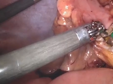 Robotic Sigmoidectomy with Intracorporeal Anastomosis using the Vijan Pop Technique Robotic Sigmoidectomy with Intracorporeal Anastomosis using the Vijan Pop Technique