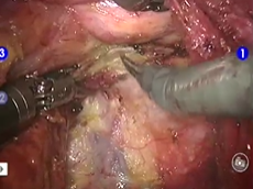 Robotic standardised abdominoperineal resection with transabdominal levator ani transection Robotic standardised abdominoperineal resection with transabdominal levator ani transection