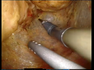 Robotic surgery may confers advantages in morbidly obese patients with low rectal cancer. Robotic surgery may confers advantages in morbidly obese patients with low rectal cancer.