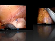 Robotic surgery may confers advantages in morbidly obese patients with low rectal cancer. Robotic surgery may confers advantages in morbidly obese patients with low rectal cancer.