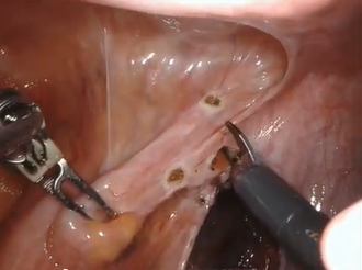 Robotic sutured rectopexy for external full?thickness rectal prolapse