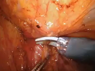 Robotic TAPP Repair of Incarcerated Femoral Hernia with Utilization of Indocyanine Green Dye Robotic TAPP Repair of Incarcerated Femoral Hernia with Utilization of Indocyanine Green Dye