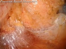 Robotic TME in a Male Patient, for a T4 Rectal Cancer after Radiotherapy