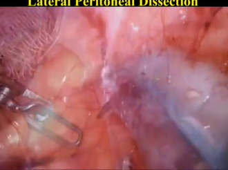 Robotic Total Intersphincteric Resection with Total Mesorectal Excision in Low Rectal Cancer Robotic Total Intersphincteric Resection with Total Mesorectal Excision in Low Rectal Cancer
