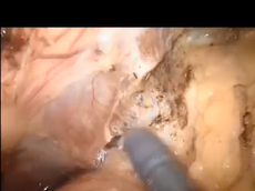 Robotic Total Pelvic Exenteration For Locally Advanced Rectal Cancer