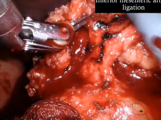 Robotic total proctocolectomy with en-masse total pelvic exenteration