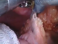 Robotic Transabdominal Intersphincteric Resection & Colo-anal Anastomosis