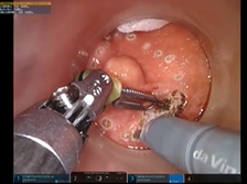 Robotic Transanal Minimally Invasive Surgery for Rectal Neuroendocrine Tumor (using Da Vinci XI) Robotic Transanal Minimally Invasive Surgery for Rectal Neuroendocrine Tumor (using Da Vinci XI)