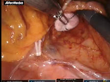Robotic ultralow anterior resection combined with trans-anal transection and coloanal anastomosis Robotic ultralow anterior resection combined with trans-anal transection and coloanal anastomosis