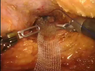 Robotic Ventral Mesh Rectopexy Technique for Rectal Intussusception with Rectocele Robotic Ventral Mesh Rectopexy Technique for Rectal Intussusception with Rectocele