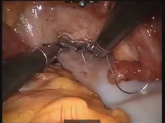 Robotic Ventral Mesh Rectopexy