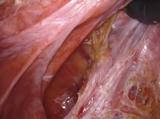 Robotic ventral re rectopexy for symptomatic rectocele recurrence A video vignette Robotic ventral re rectopexy for symptomatic rectocele recurrence A video vignette