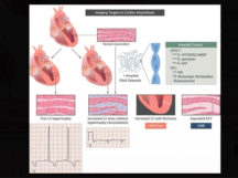 Role of purkinje fibres in Ventricular Fibrillation