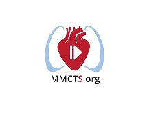 Rotation of the outflow tracts for complex transposition of the great arteries Rotation of the outflow tracts for complex transposition of the great arteries
