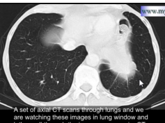Rounded atelectasis - CT scan of Chest Rounded atelectasis - CT scan of Chest