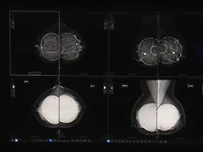 RSNA 2017 Pristina Dueta and SenoIris workstation demo RSNA 2017 Pristina Dueta and SenoIris workstation demo