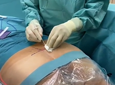 Sacral Neuromodulation for faecal incontinence using the new InterstimTM Micro System Sacral Neuromodulation for faecal incontinence using the new InterstimTM Micro System