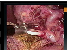 SAGES/ALACE Symposium: Common Bile Duct Exploration Options When You Don't Have Everything SAGES/ALACE Symposium: Common Bile Duct Exploration Options When You Don't Have Everything