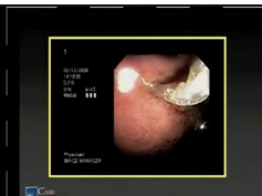 SAGES/ALACE Symposium: Endoscopic Management Of Complications Stent Technique