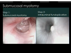 Sages/Alace Symposium: Trans-Esophageal Surgery - Heller