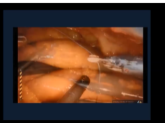 SAGES HPB Facebook All Things Bile Duct Injury Livestream SAGES HPB Facebook All Things Bile Duct Injury Livestream