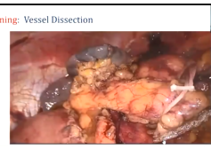 SAGES HPB Facebook Group All Things Distal Pancreatectomy Livestream SAGES HPB Facebook Group All Things Distal Pancreatectomy Livestream
