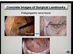 SAGES/JSES - Lower GI Surgery Symposium: Rectal Cancer SAGES/JSES - Lower GI Surgery Symposium: Rectal Cancer