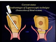 SAGES/JSES - Lower GI Surgery Symposium: Robotic Surgery of the Rectum-2 SAGES/JSES - Lower GI Surgery Symposium: Robotic Surgery of the Rectum-2