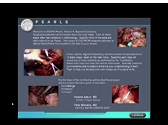 SAGES Pearls Session: Laparoscopic Sigmoid Colectomy Introduction - Peter Marcello SAGES Pearls Session: Laparoscopic Sigmoid Colectomy Introduction - Peter Marcello