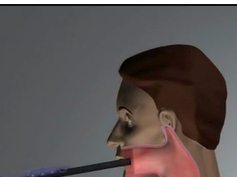 SAGES Pearls Session: Laparoscopic Sigmoid Colectomy - Technique Video SAGES Pearls Session: Laparoscopic Sigmoid Colectomy - Technique Video